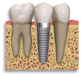 Tooth implants visual